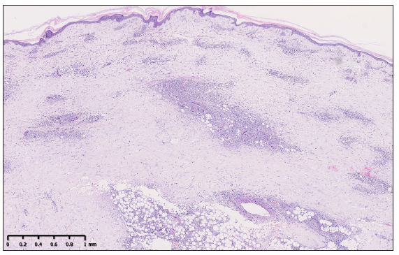 Histopathological examination showed a dermal and subcutaneous infiltration of atypical lymphoid cells, with angiocentricity. (Haematoxylin and eosin, 40x)